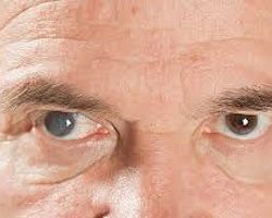 Глаукома (жовта вода)